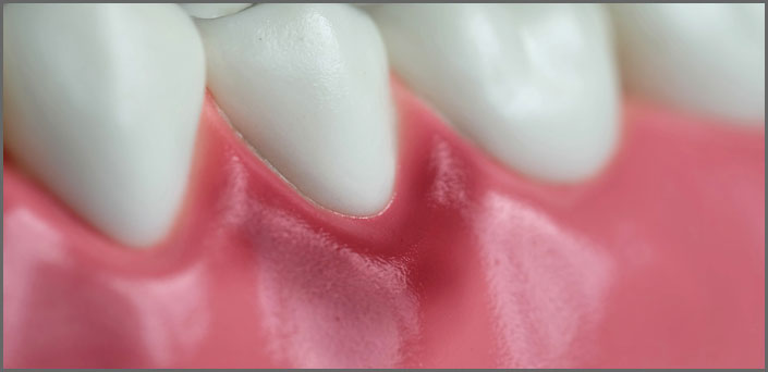 θεραπεία ουλίτιδας  οδοντιατρεια πειραια