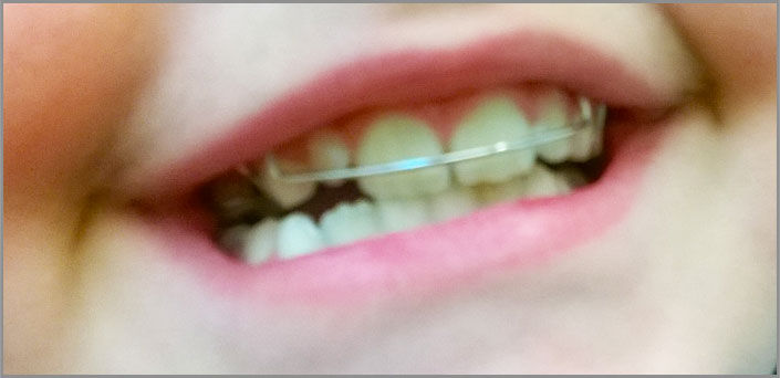 therapy for children