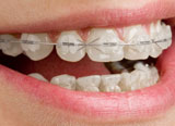braces pasalimani