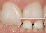 edelweiss veneers