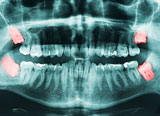 surgical tooth extraction
