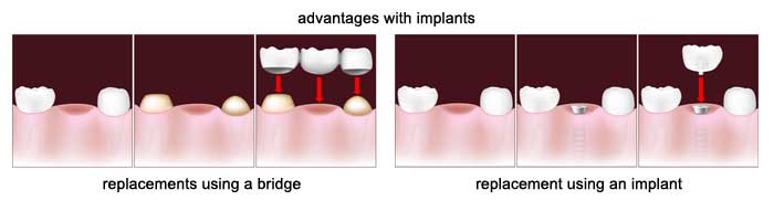 implants vs bridge