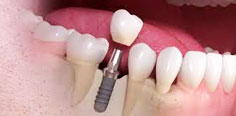 tooth implant