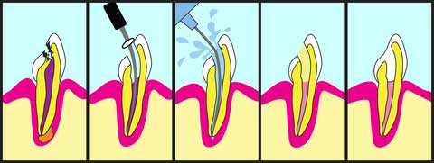 root canals