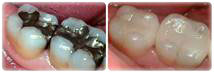 ceramic fillings