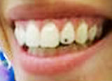 tooth strass