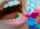 intradental cleaning