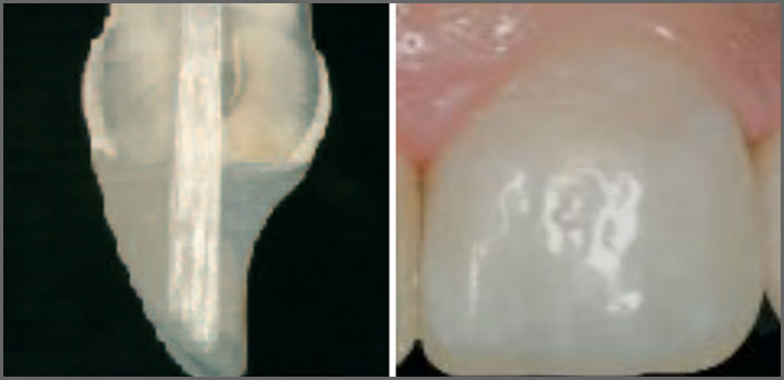 shaft reconstitutions