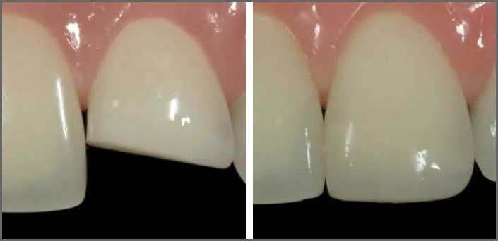 where bonding is indicated