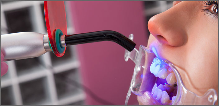 whitening at the dentist