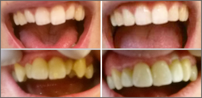 λιφτινγ στα δοντια