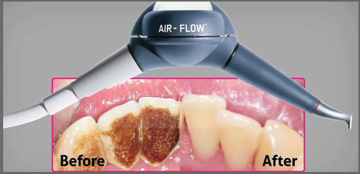 air polishing peiraias