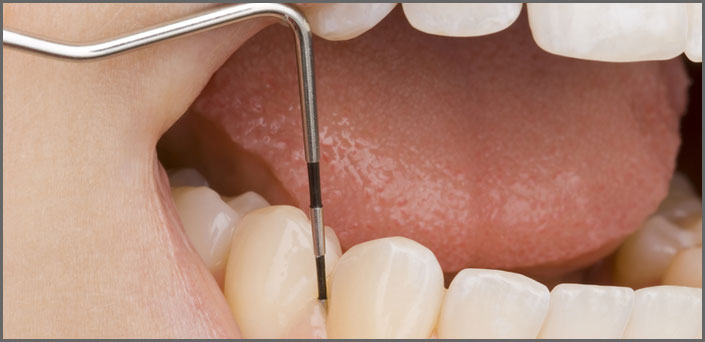 θεραπεία περιοδοντίτιδας