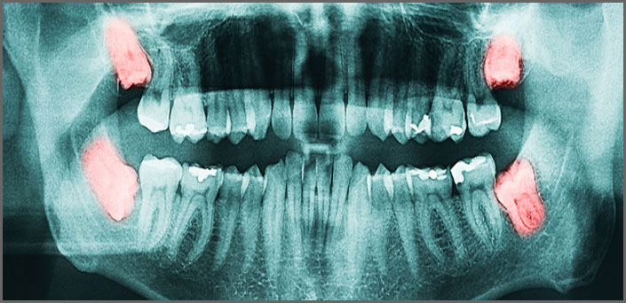 surgical extractions