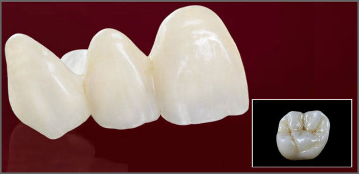 zirconium replacements